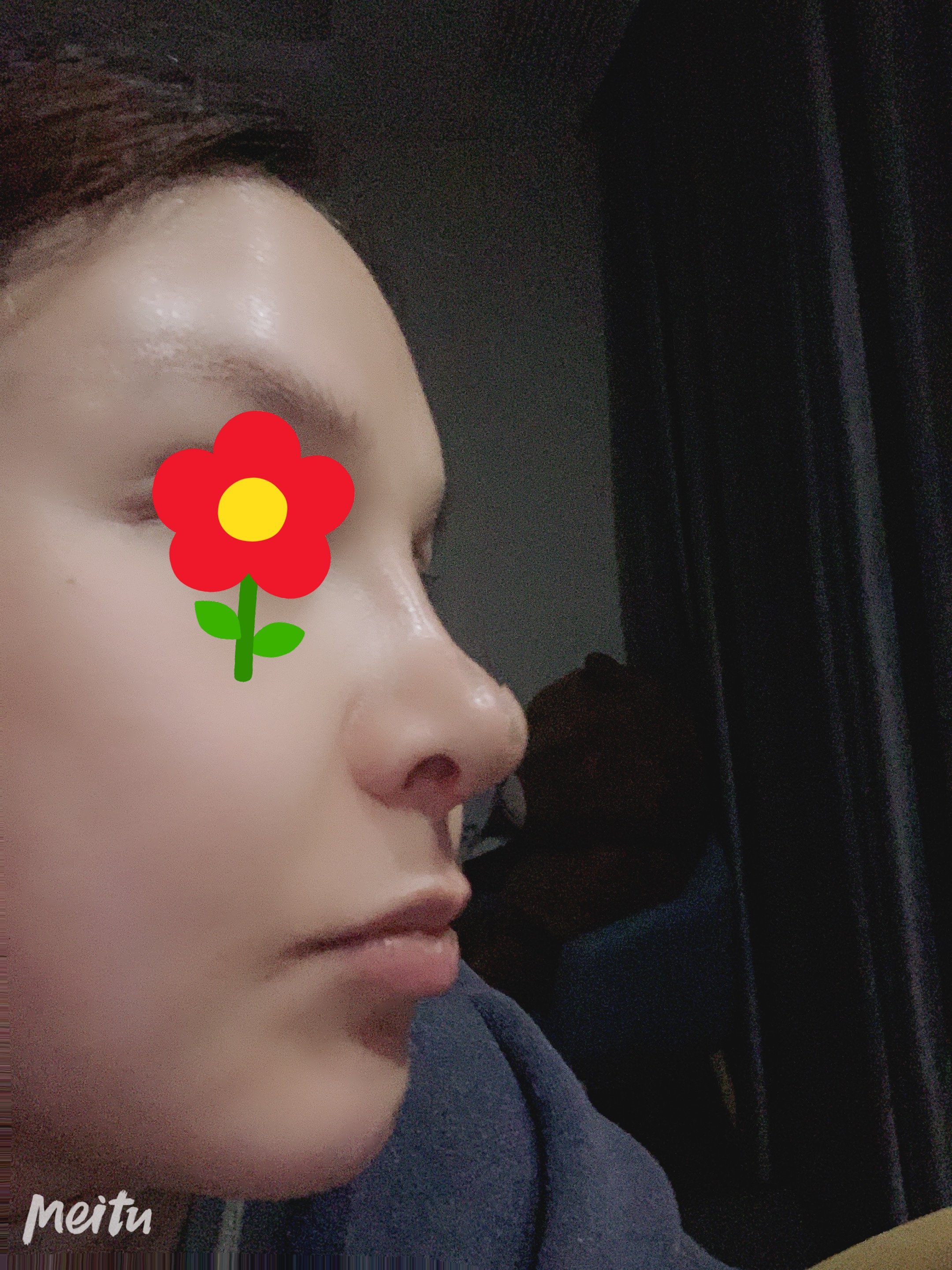 请问半肋软骨加膨体隆鼻鼻小柱鼻基底填充等手术消肿期是多久做完现在