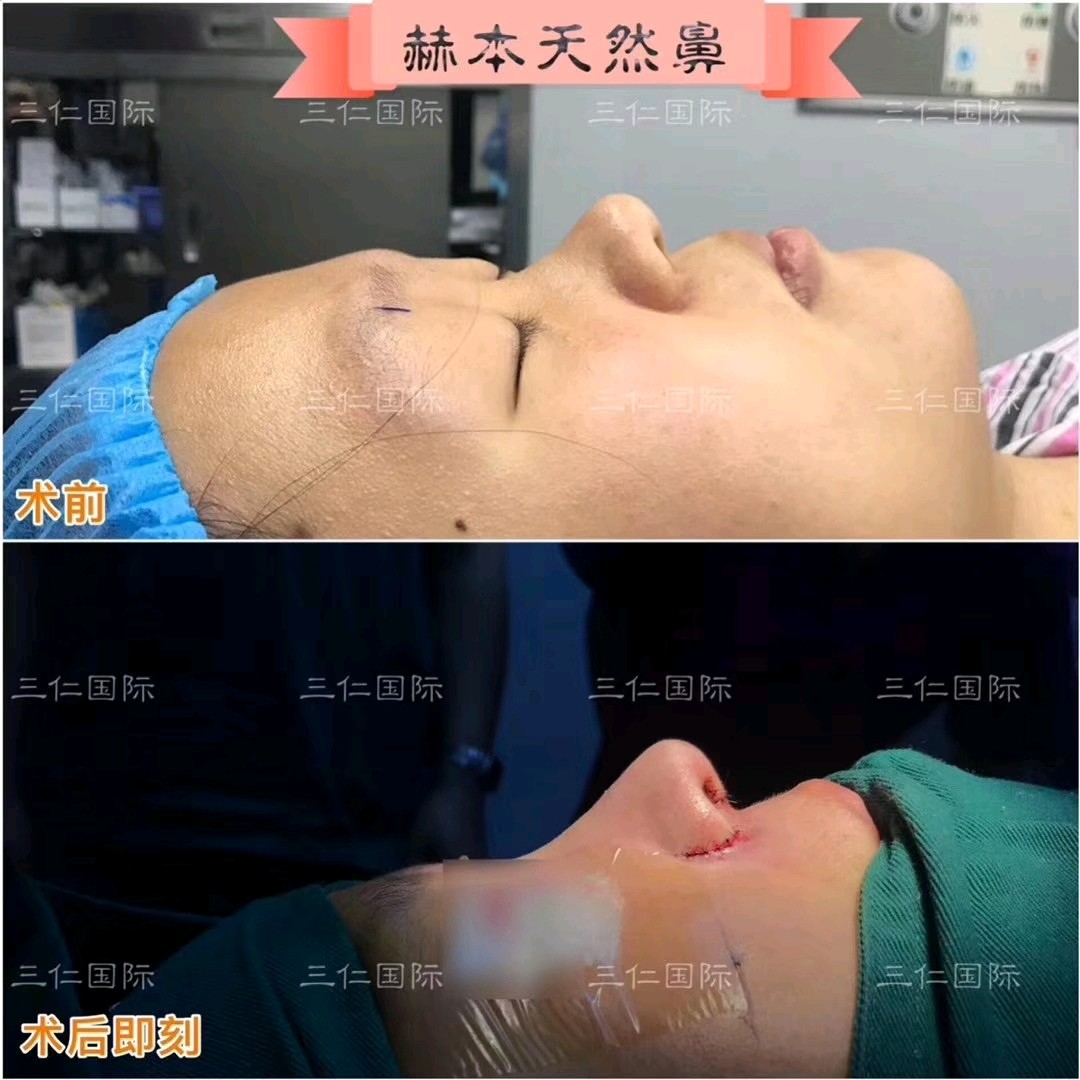 鼻翼缩小术 与西方人不同,亚洲人的鼻孔和鼻子宽,向_圈子-新氧美容