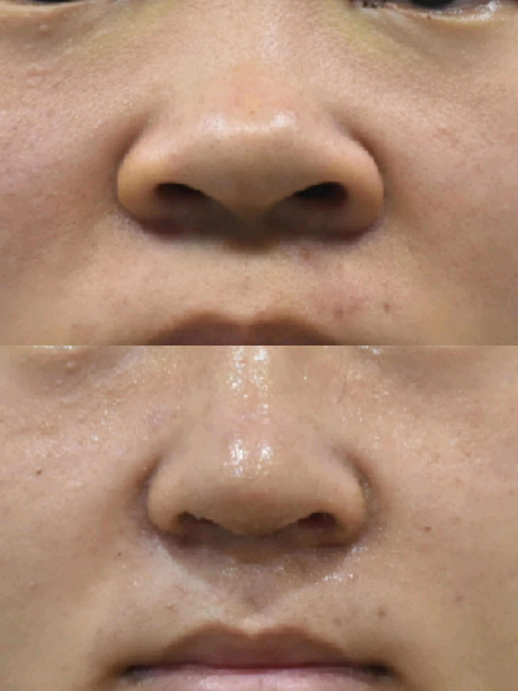 鼻翼缩小术 与西方人不同,亚洲人的鼻孔和鼻子宽,向