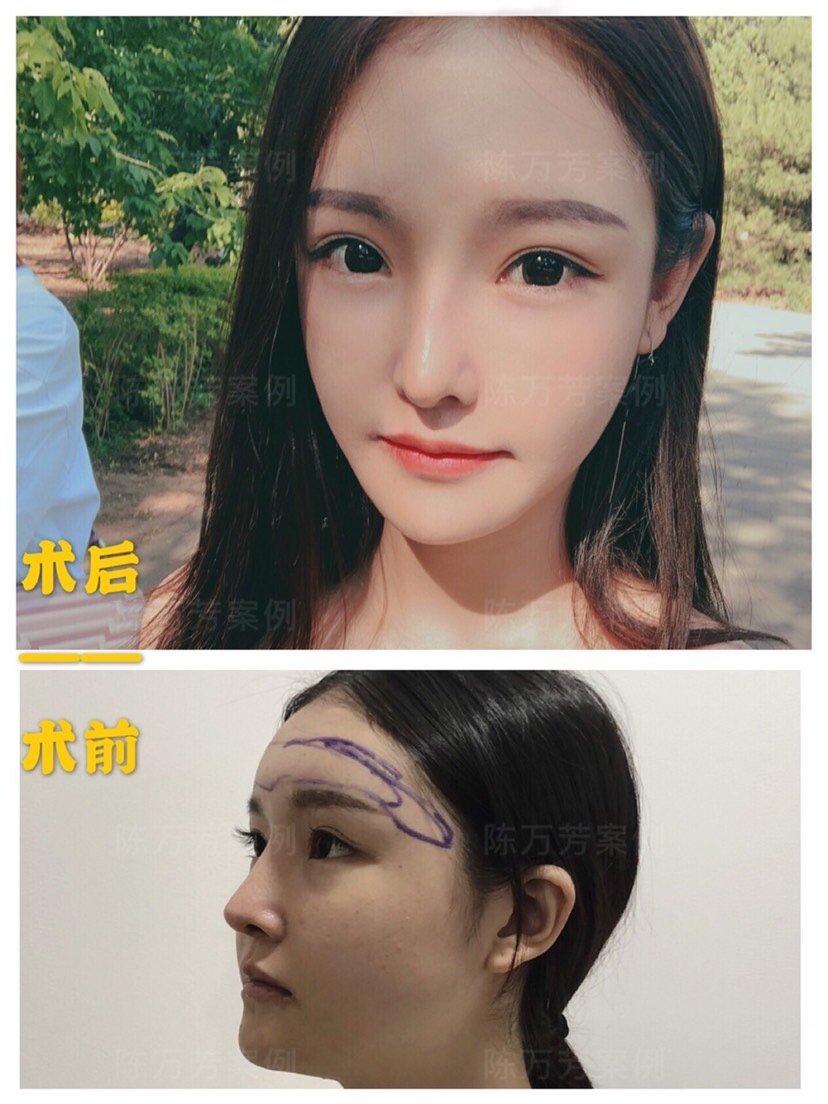 面部脂肪填充失败后怎么修复 新氧美容整形 面部脂肪填充失败后怎么修复 新氧美容整形