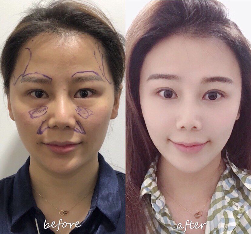 我的额头比较平是用脂肪填还是玻尿酸填呢