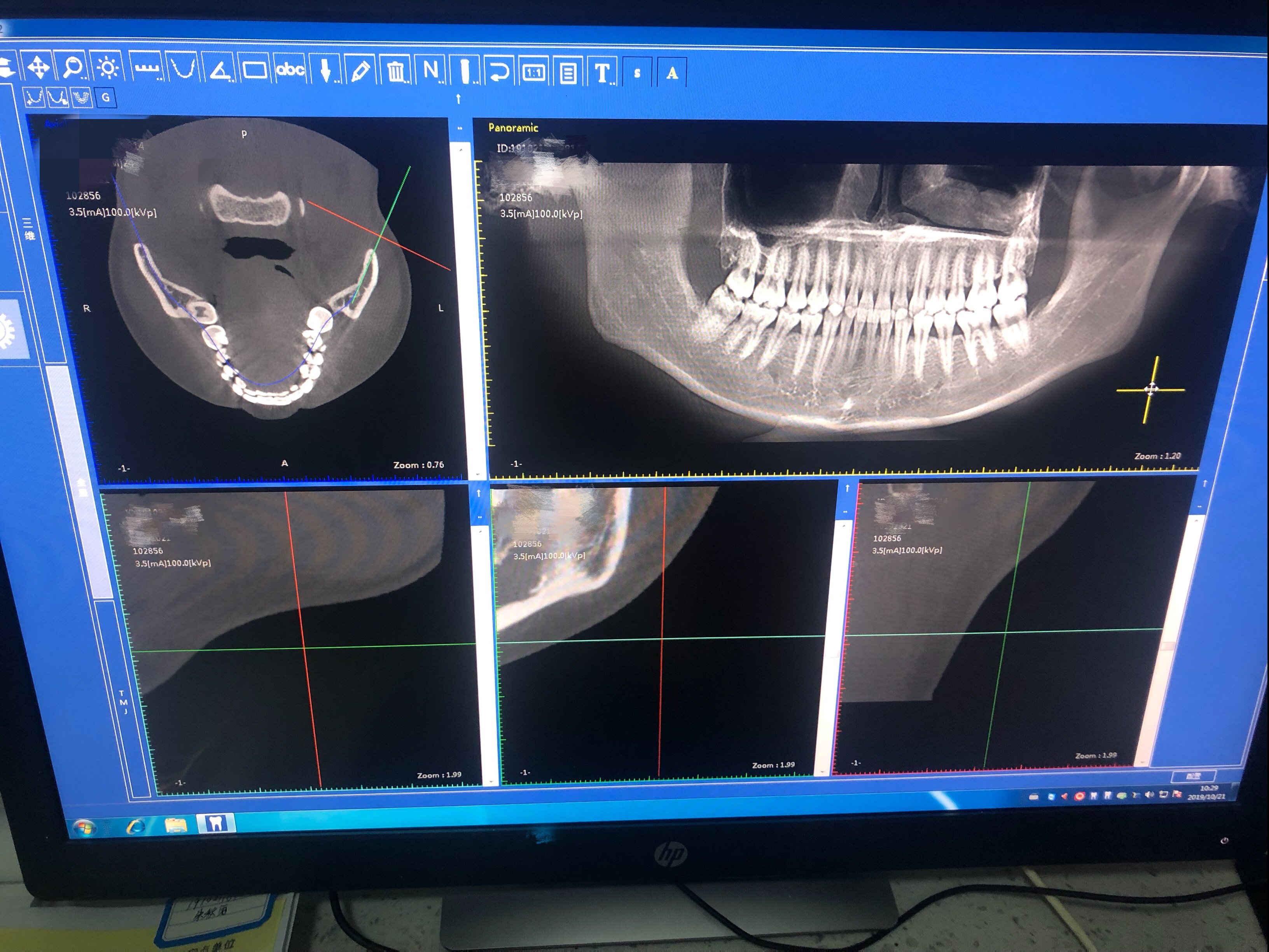 牙中线不齐偏颌