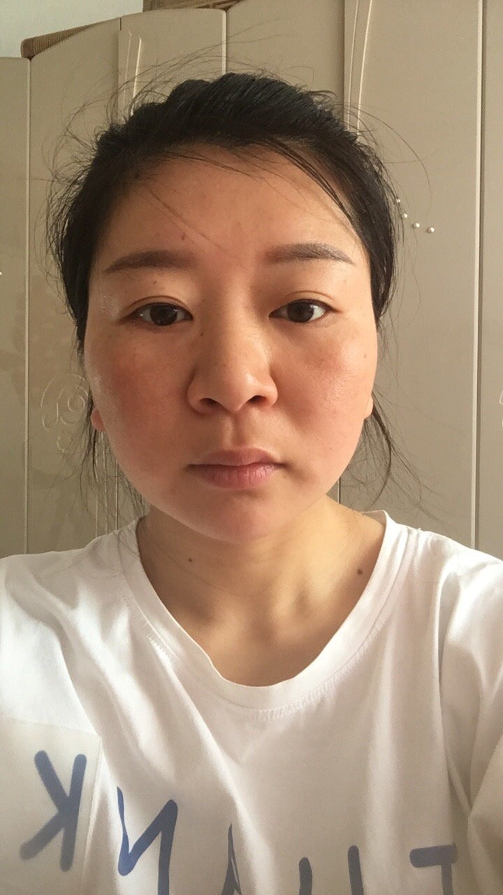 我做热拉提有用吗最近感觉皮肤松弛下垂想通过仪器使脸部紧致提升