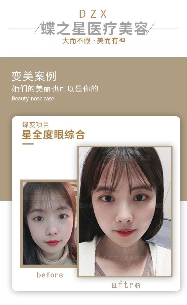 双眼皮失败 请问做修复容易吗我眼睛比 新氧美容整形