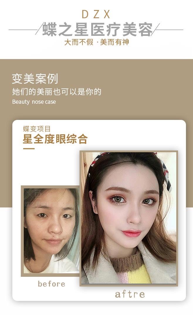 双眼皮失败 请问做修复容易吗我眼睛比 新氧美容整形