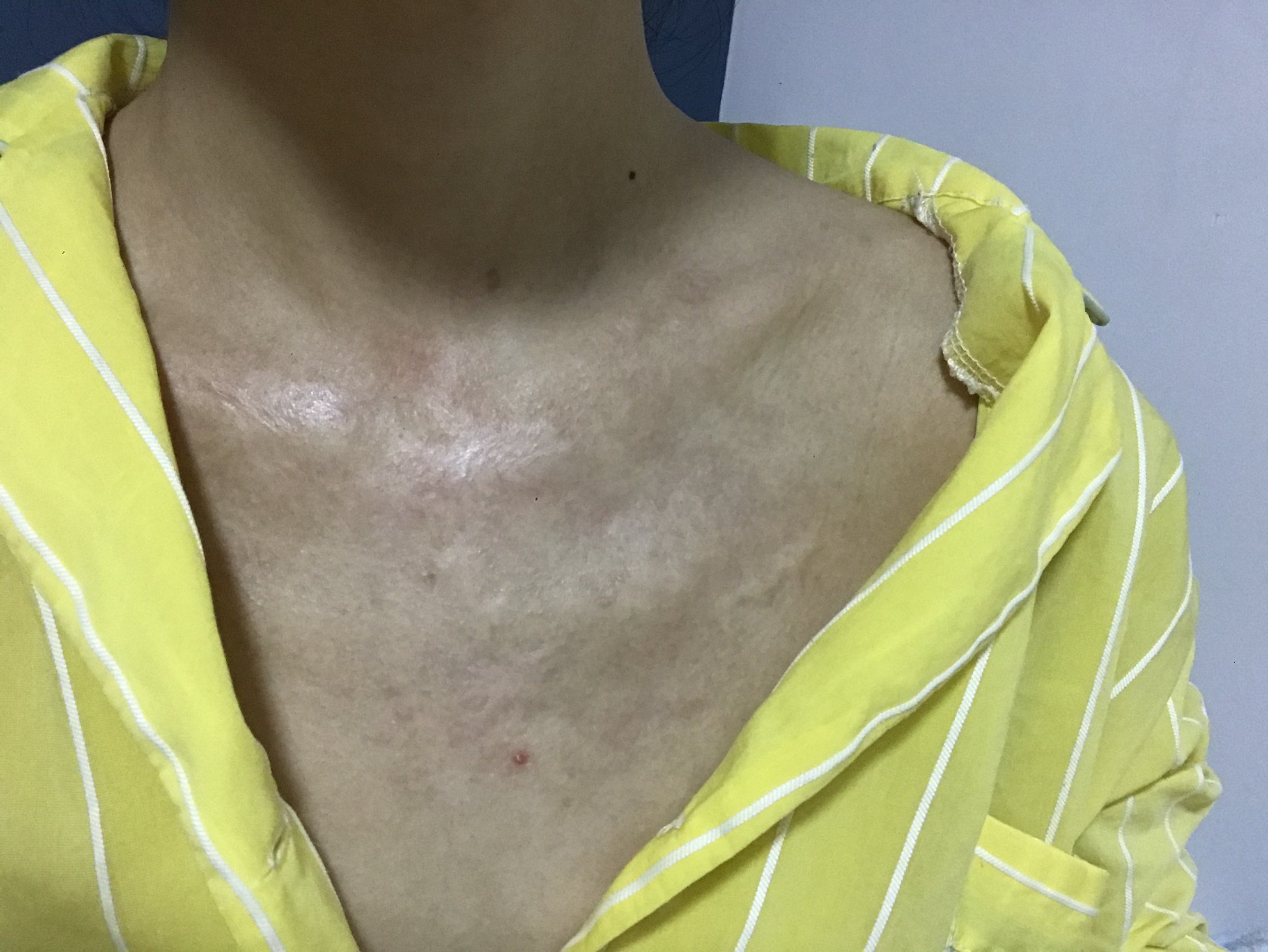 陈年烫伤疤痕有什么修复方法吗