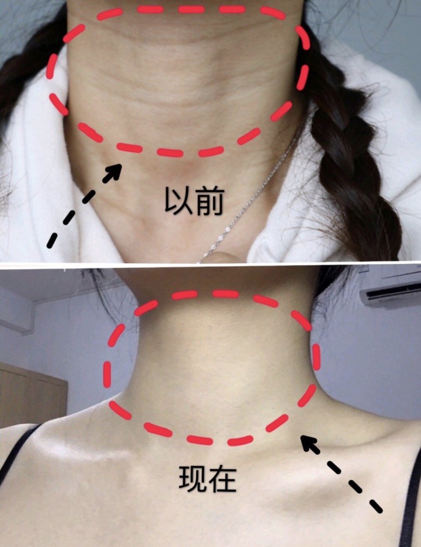 嗨体去颈纹能维持多久