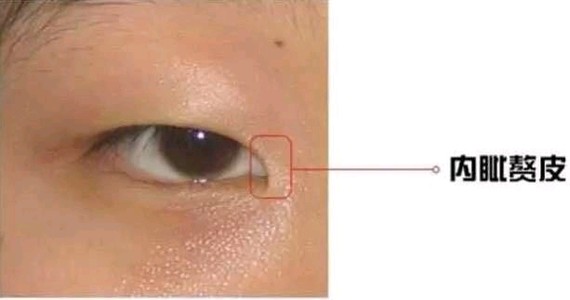 一块皮肤,把你眼角包了起来,把本该露出来的红色肉肉(红色泪阜)遮住了