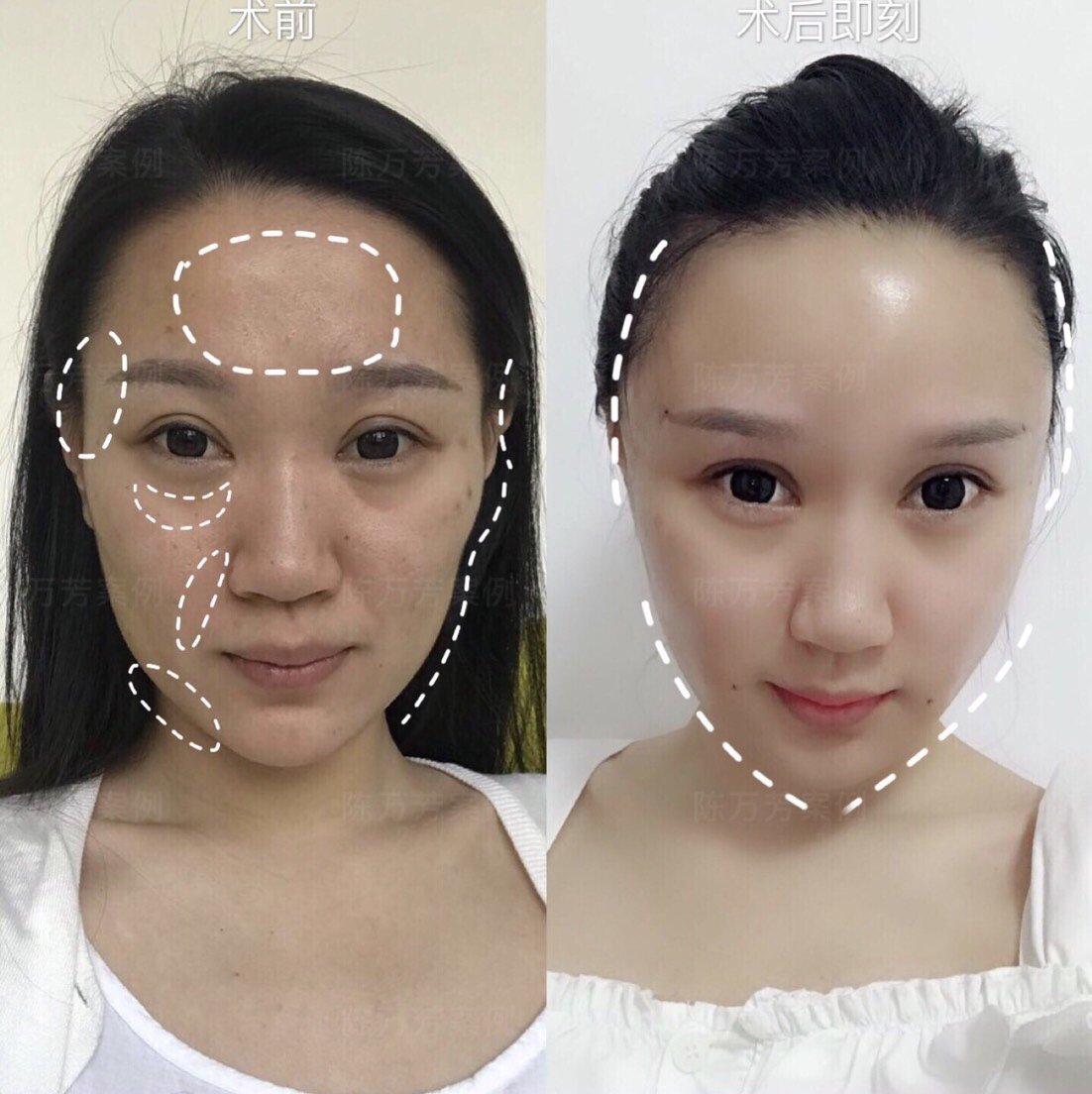 了仔细看额头上有点凸凹不平不知道是填充失败还是做填充都是这种效果