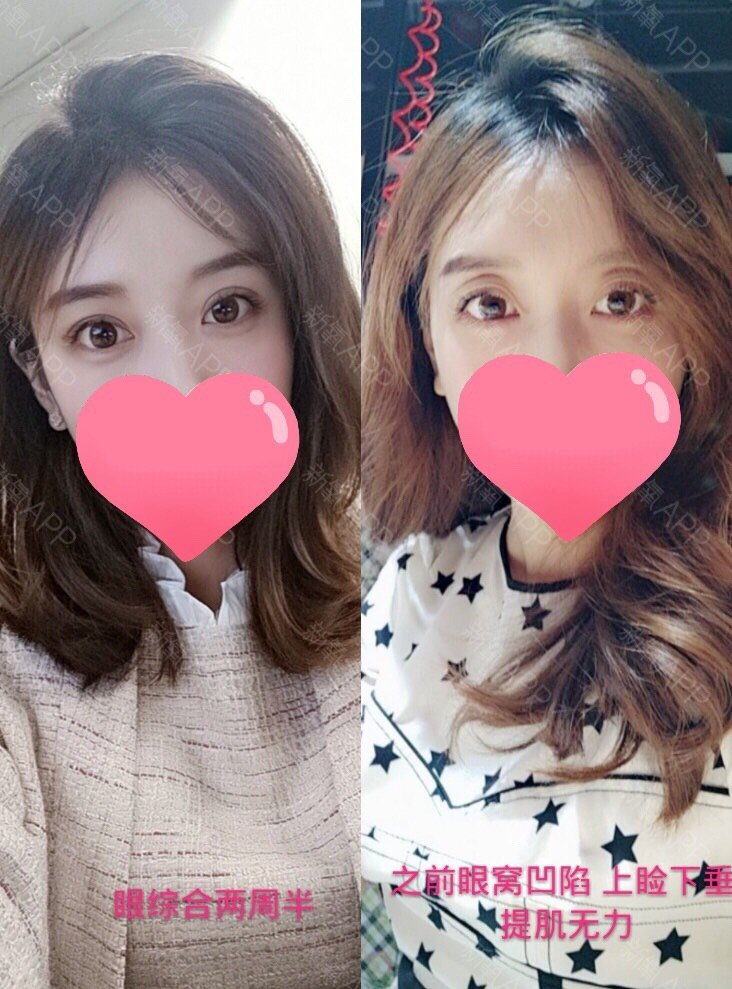 眼窝凹陷眼皮松弛只能做双眼皮改善?