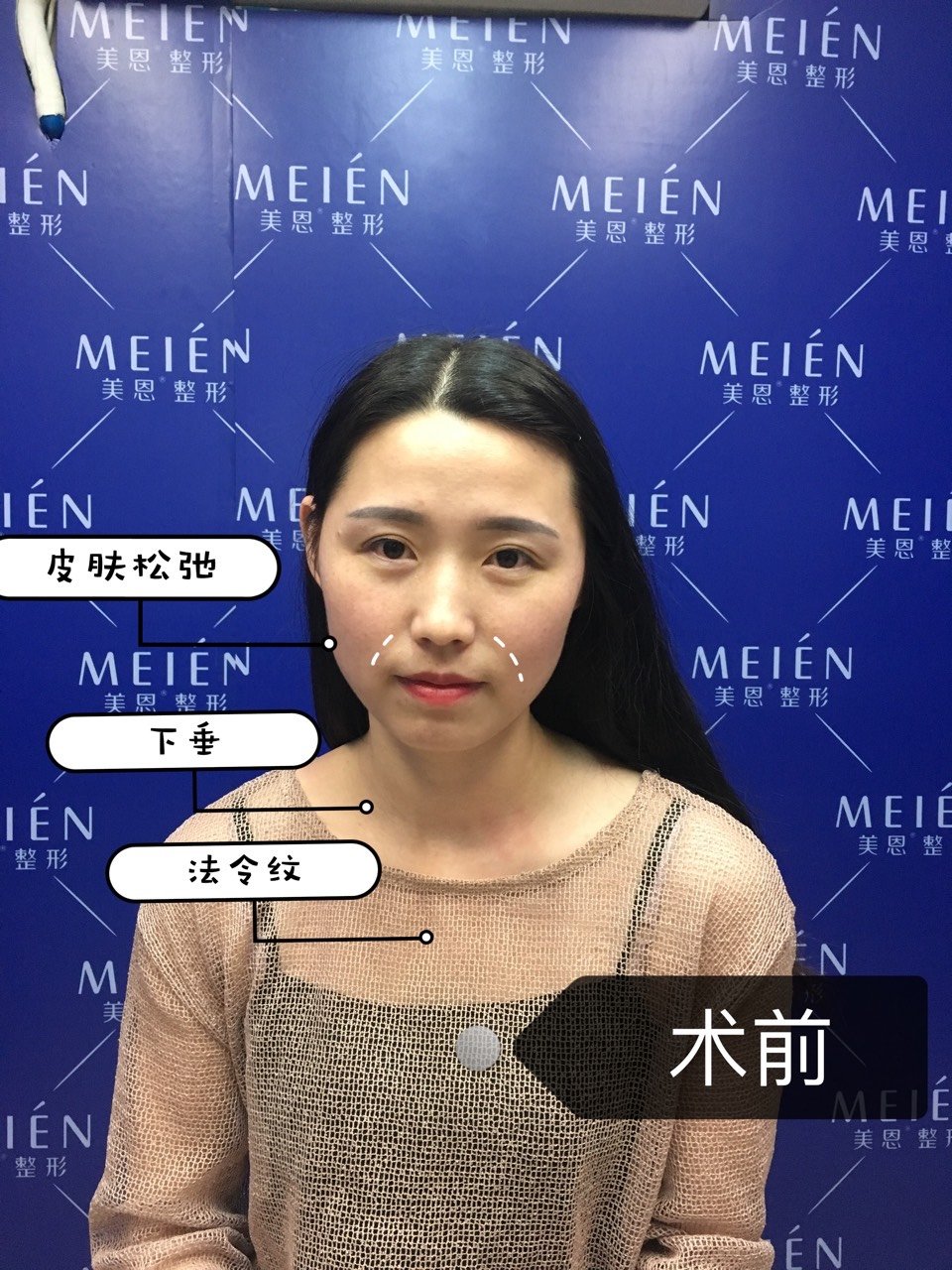 🔥#盘点#为什么热玛吉的面部治疗不包含眼睛 🍉有_圈子-新氧美容整形