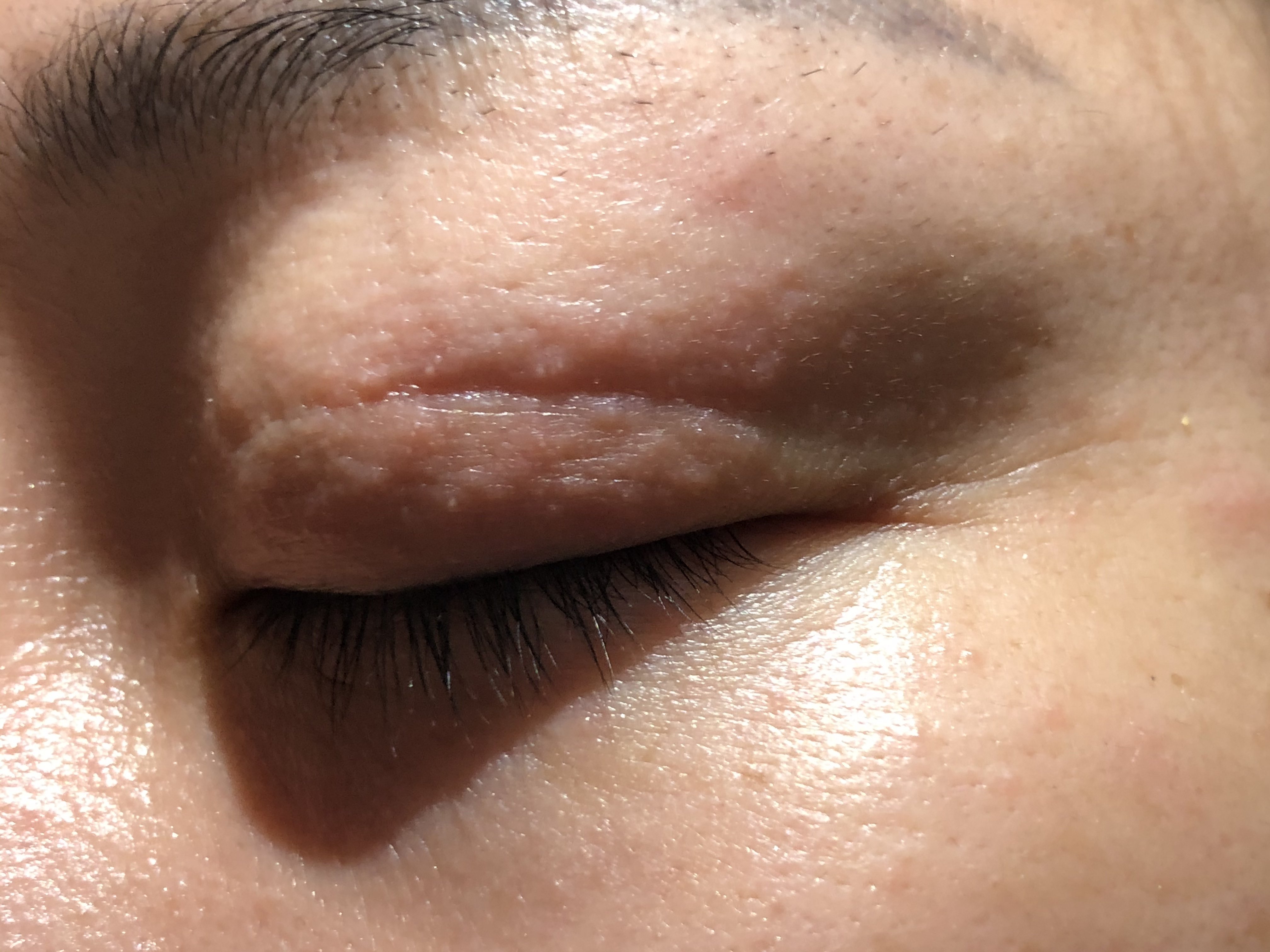 这应该是过敏了,打过5.6年肉毒了,从来没遇到过这_圈子-新氧美容整形