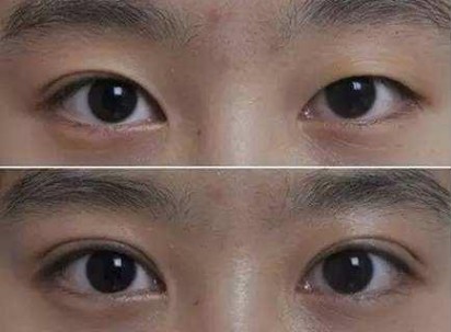 眼睛一大一小,怎么办?