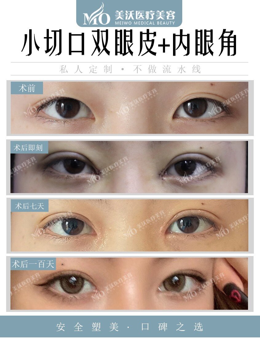 首页 此页面仅支持预览 Avatar 孔伟立 1110篇日记 商品 查看 眼部综合 专注眼部整形孔伟立 Park法切开双眼皮 开内眼角 翘眼尾 祛皮祛脂 孔伟立 长沙美沃医疗美容 已售258 小切口双眼皮仅限于无松弛 单薄 条件好的案例 恢复快是其优点 去不了