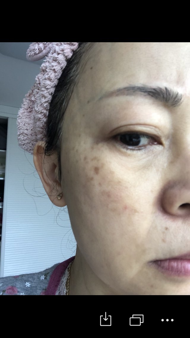 皮秒后反黑怎么办