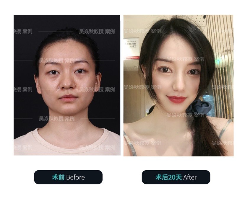 抽脂去眼袋费用一般在多少 哪些因素会影响价格发生变化 爱美网 整形美容资讯平台