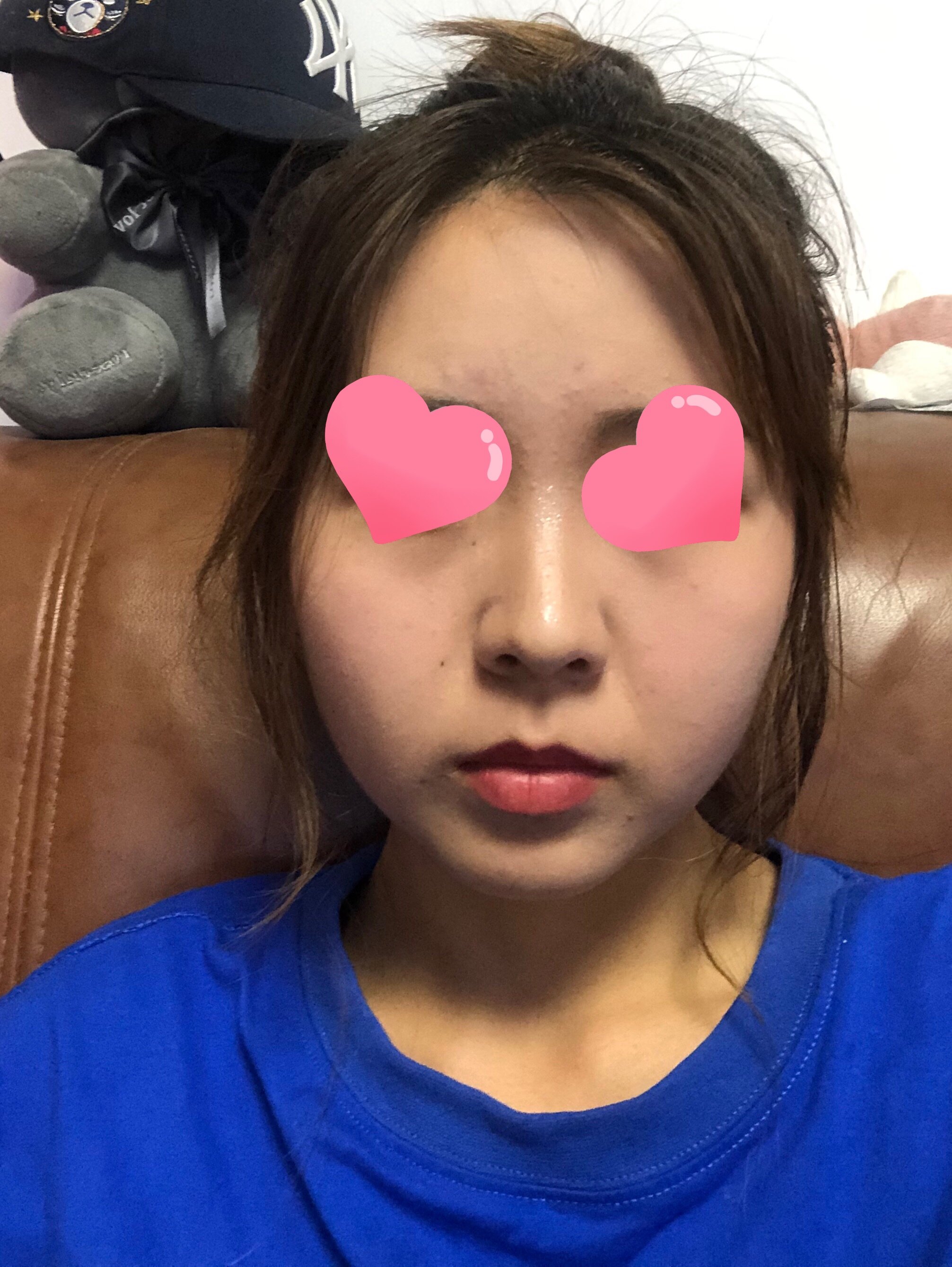 脸上婴儿肥嘟嘟肉皮肤松弛我是该吸脂还是做热提拉好啊啊