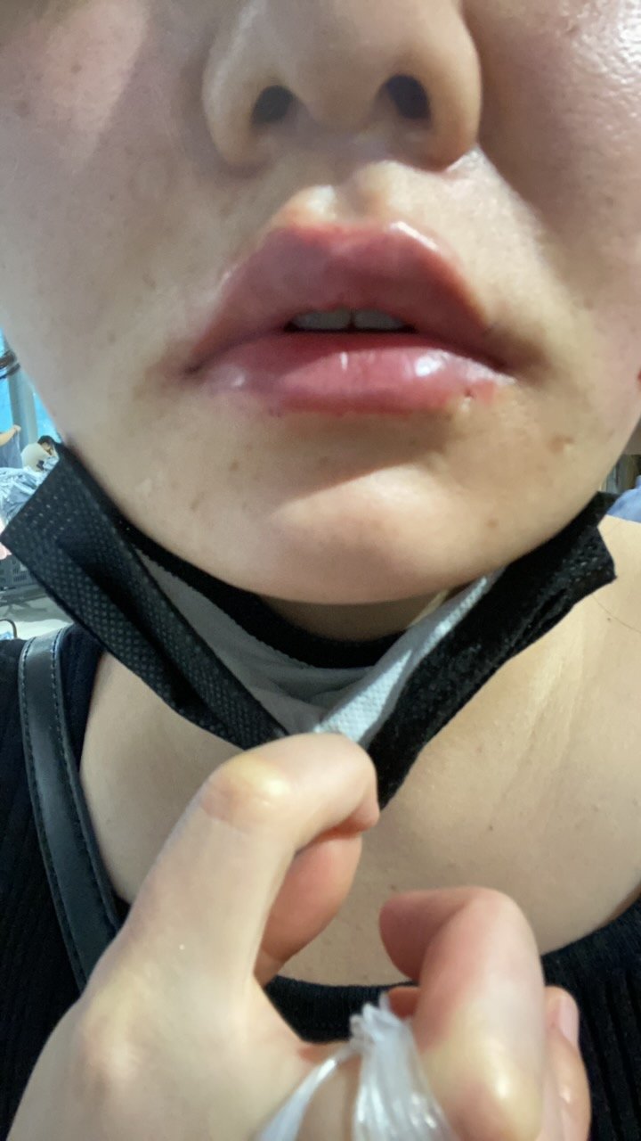 就是肿,没有别人说的各种不舒服,不能大笑,嘴扯着有点不舒服