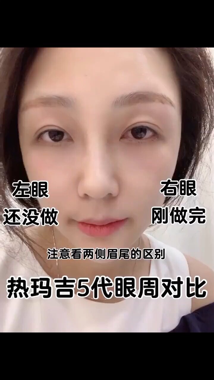 热玛吉5代眼周对比