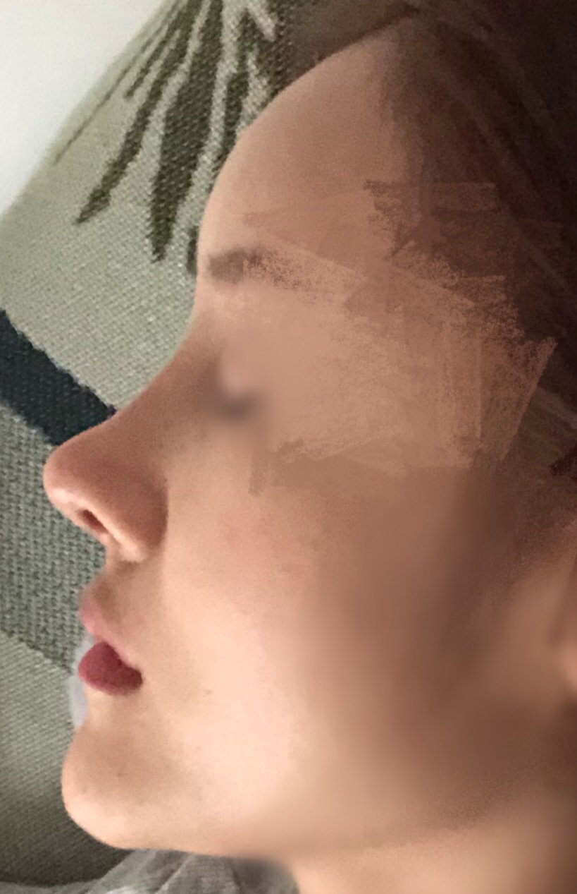 耳软骨隆鼻拆线的第天感觉山根太高鼻尖太翘弧度不好看