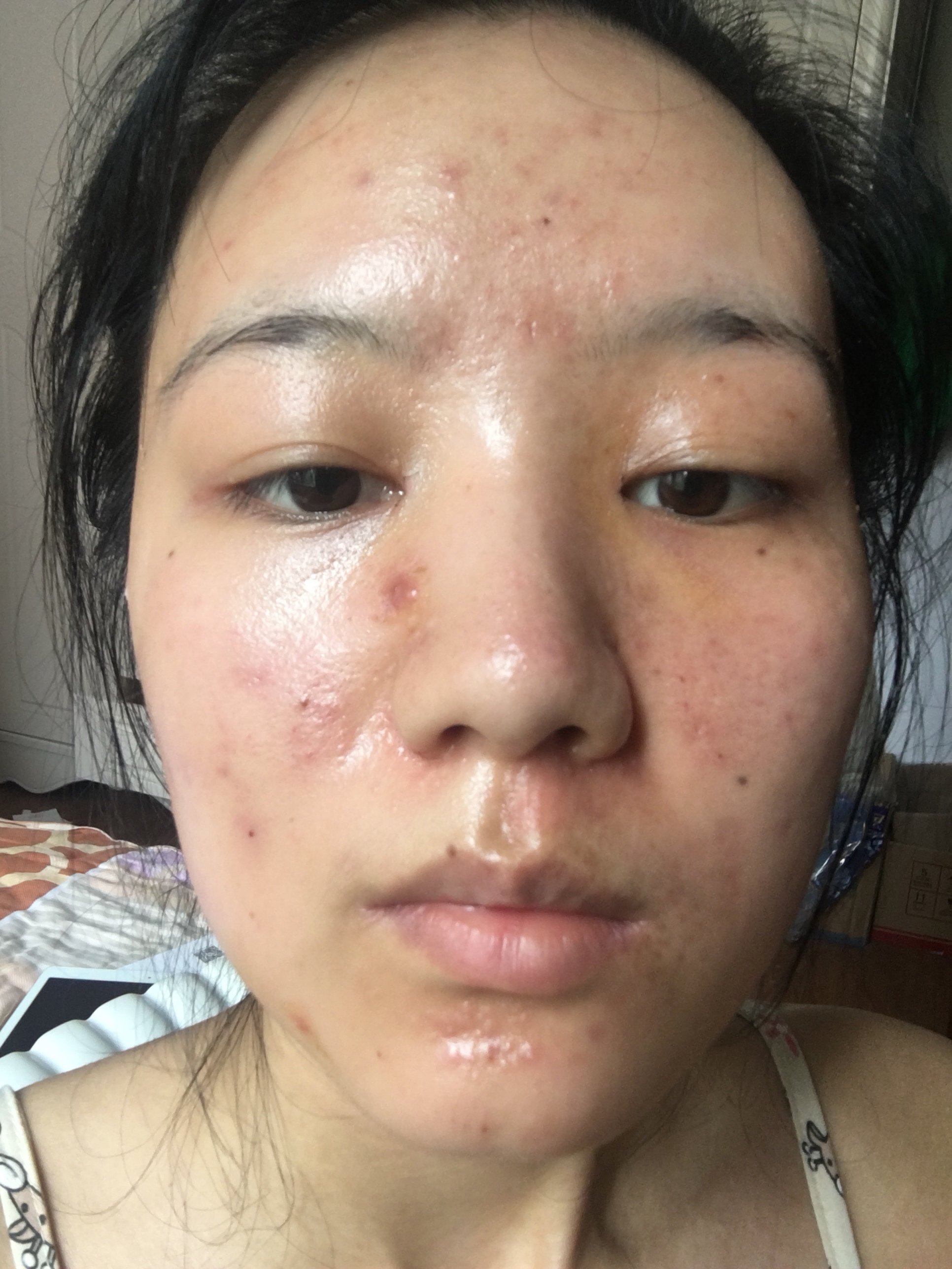 今天没昨天那么红了 相比刚做完红肿成小龙虾02 今天_圈子-新氧美容