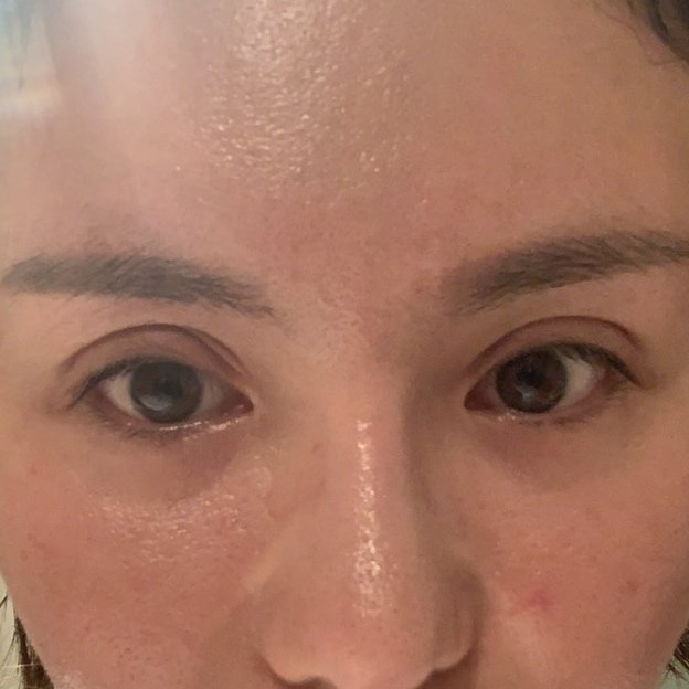 全切双眼皮术后变成凹陷三眼皮是不是失败了