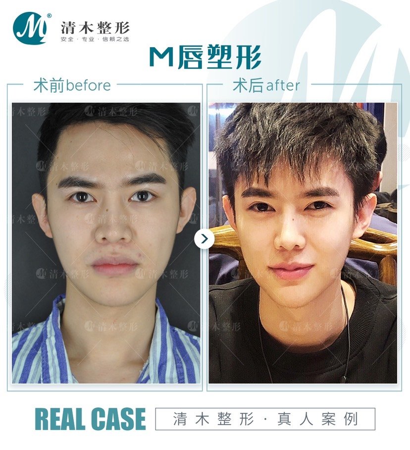 m唇手术会留疤吗