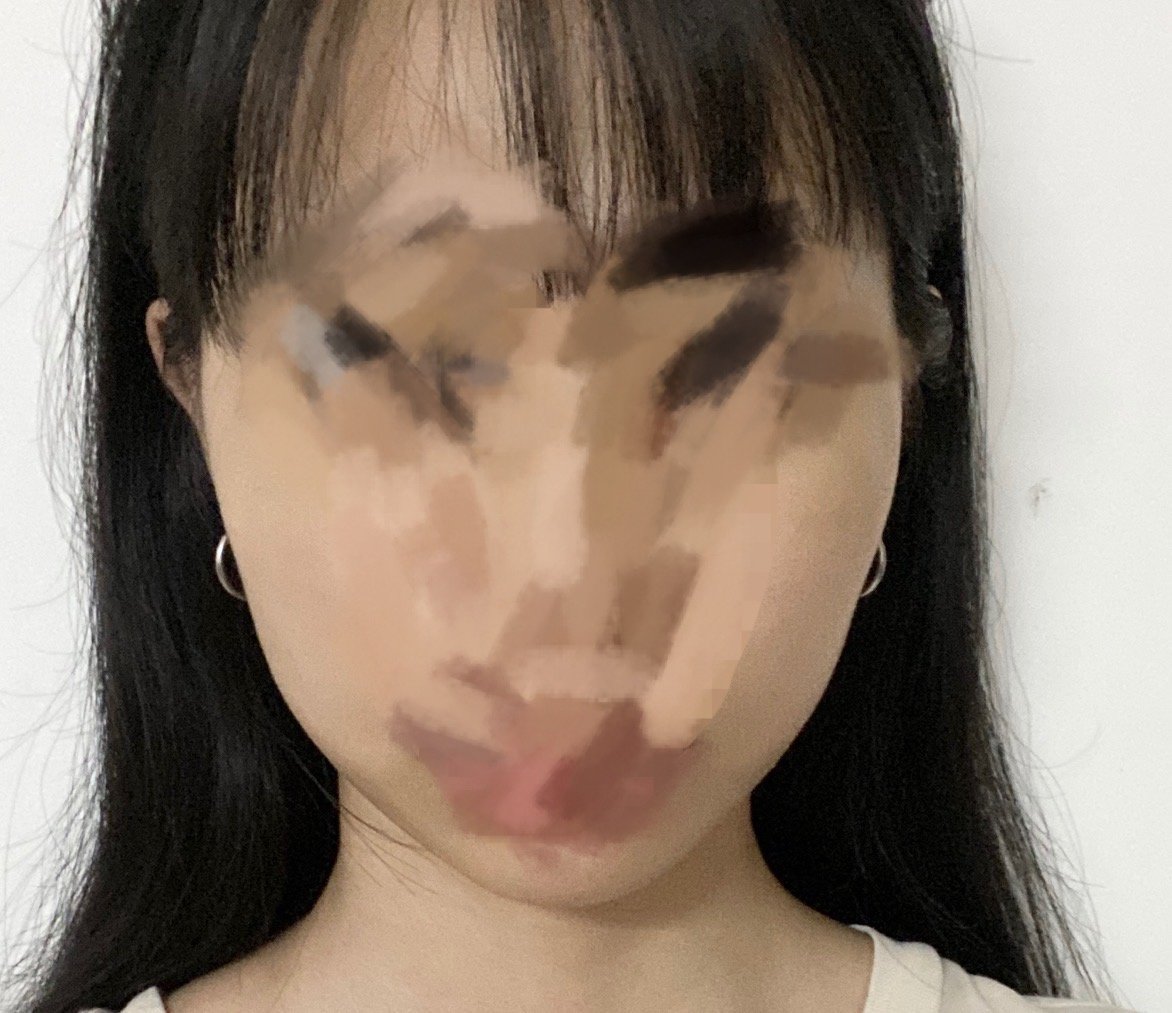 打了瘦脸针我的脸是凹陷了吗