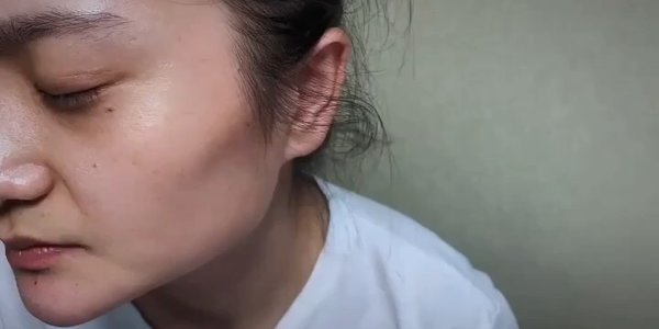 面颊凹陷怎么办?