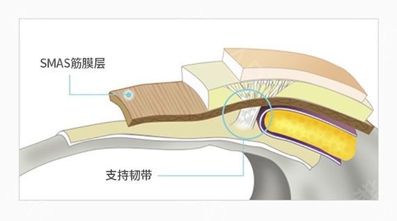 面部提升手术为什么要提升smas筋膜层提升表皮效果不好吗