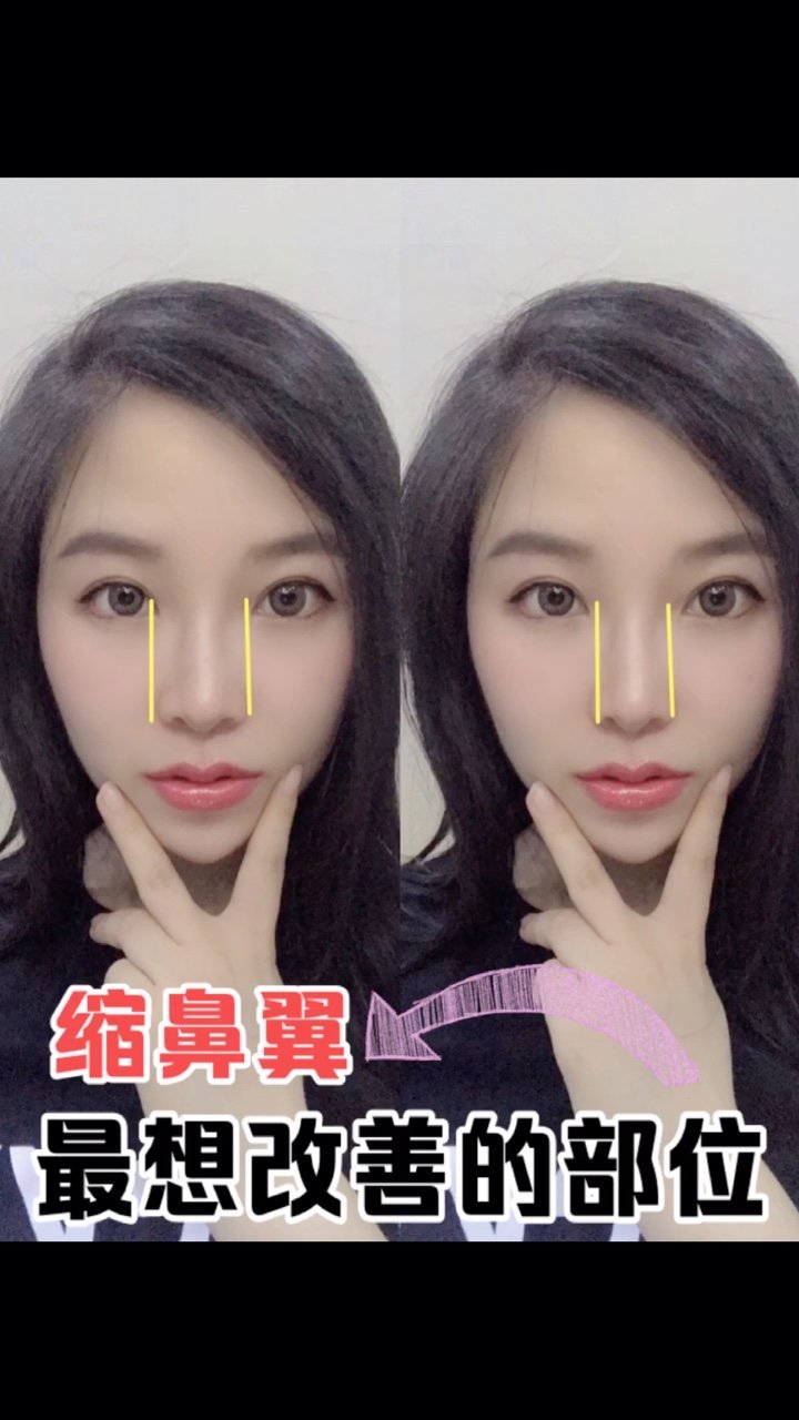 最想做的项目之缩鼻翼宽鼻翼看上去有点粗糙感窄一些更显精致新氧榜姐