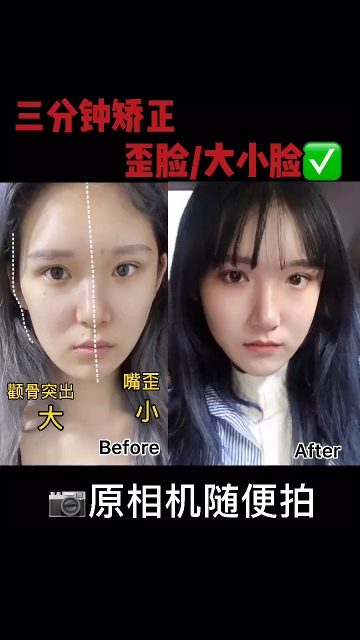脸型矫正|告别嘴歪/大小脸提升颜值 瘦脸_圈子-新氧美容整形
