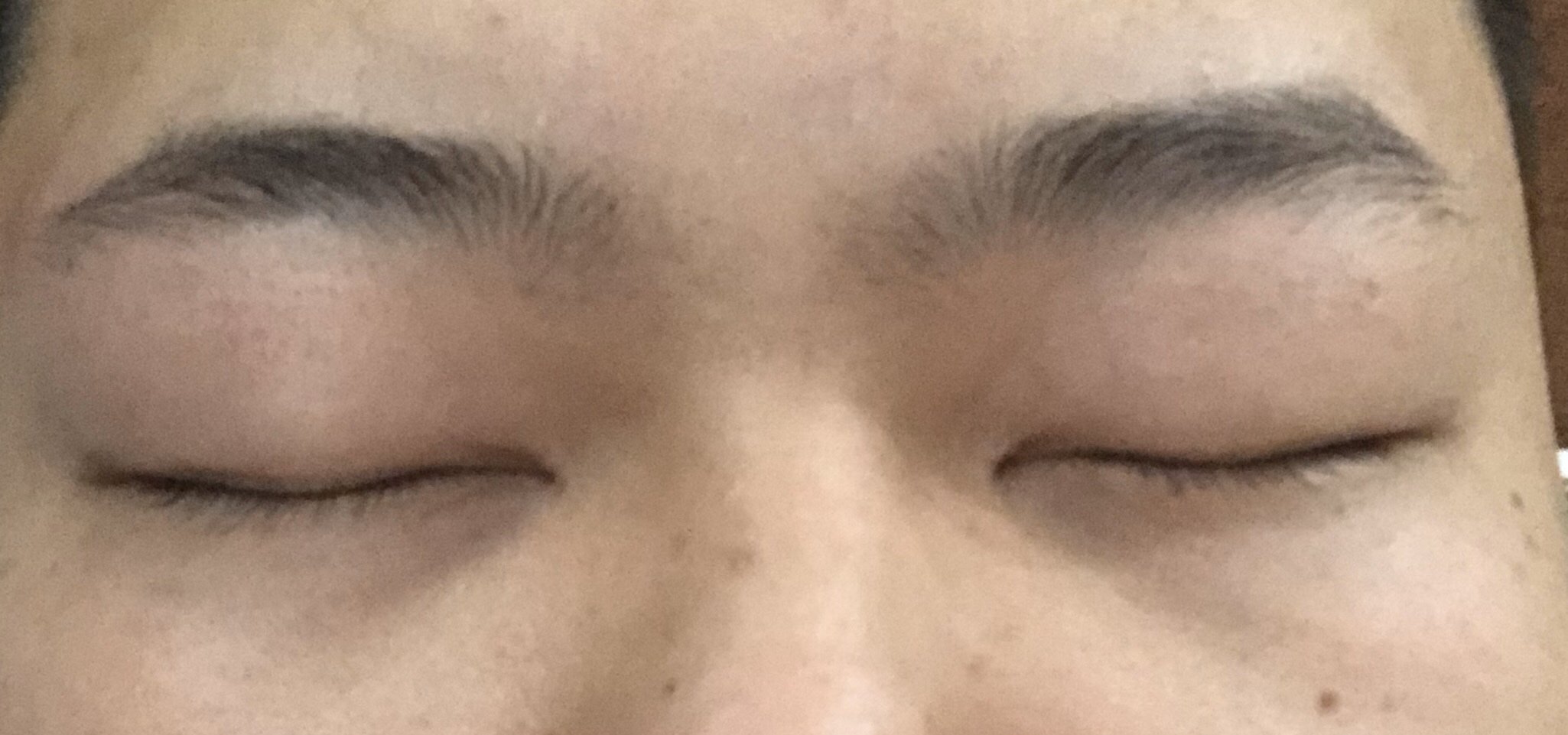 上眼睑下垂上眼睑肌无力肿泡眼