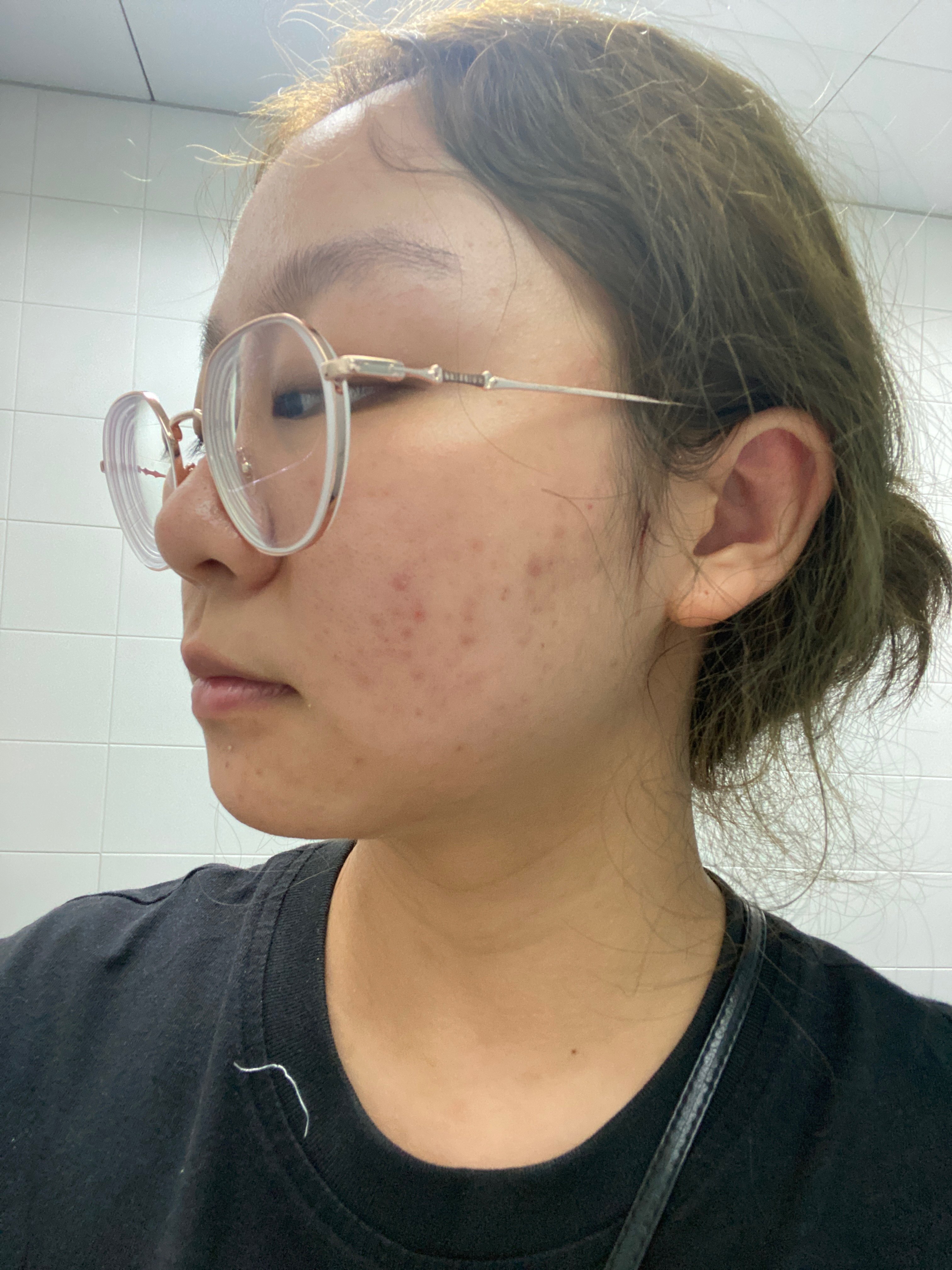 有些泛红,昨日新发出来了几粒白头粉刺和一颗火山痘今天已经消退了,全