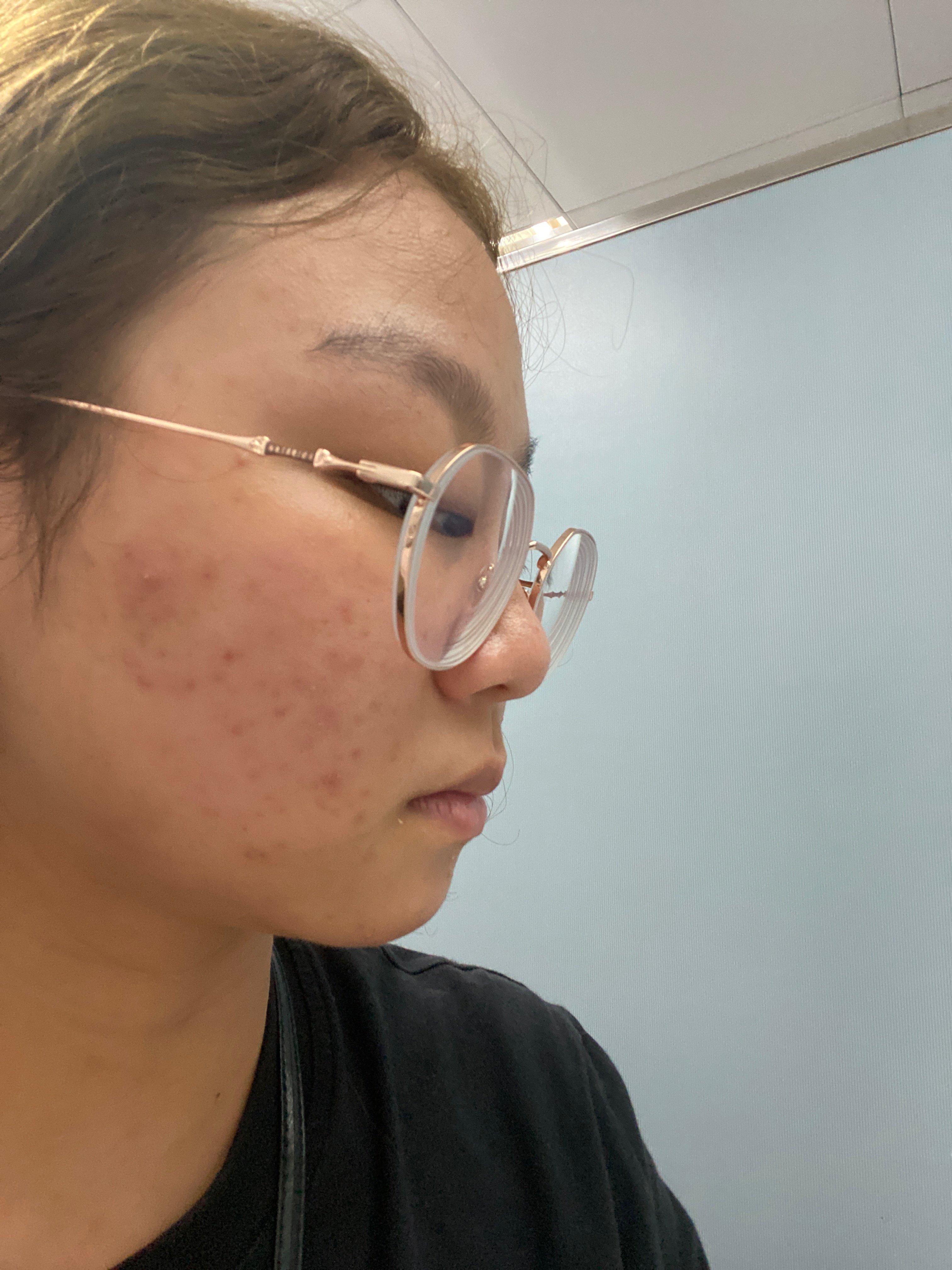 有些泛红,昨日新发出来了几粒白头粉刺和一颗火山痘今天已经消退了,全