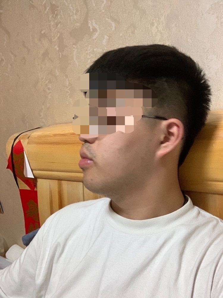 嘴巴侧面很难看这种情况是牙突导致的还是嘴唇厚导致的