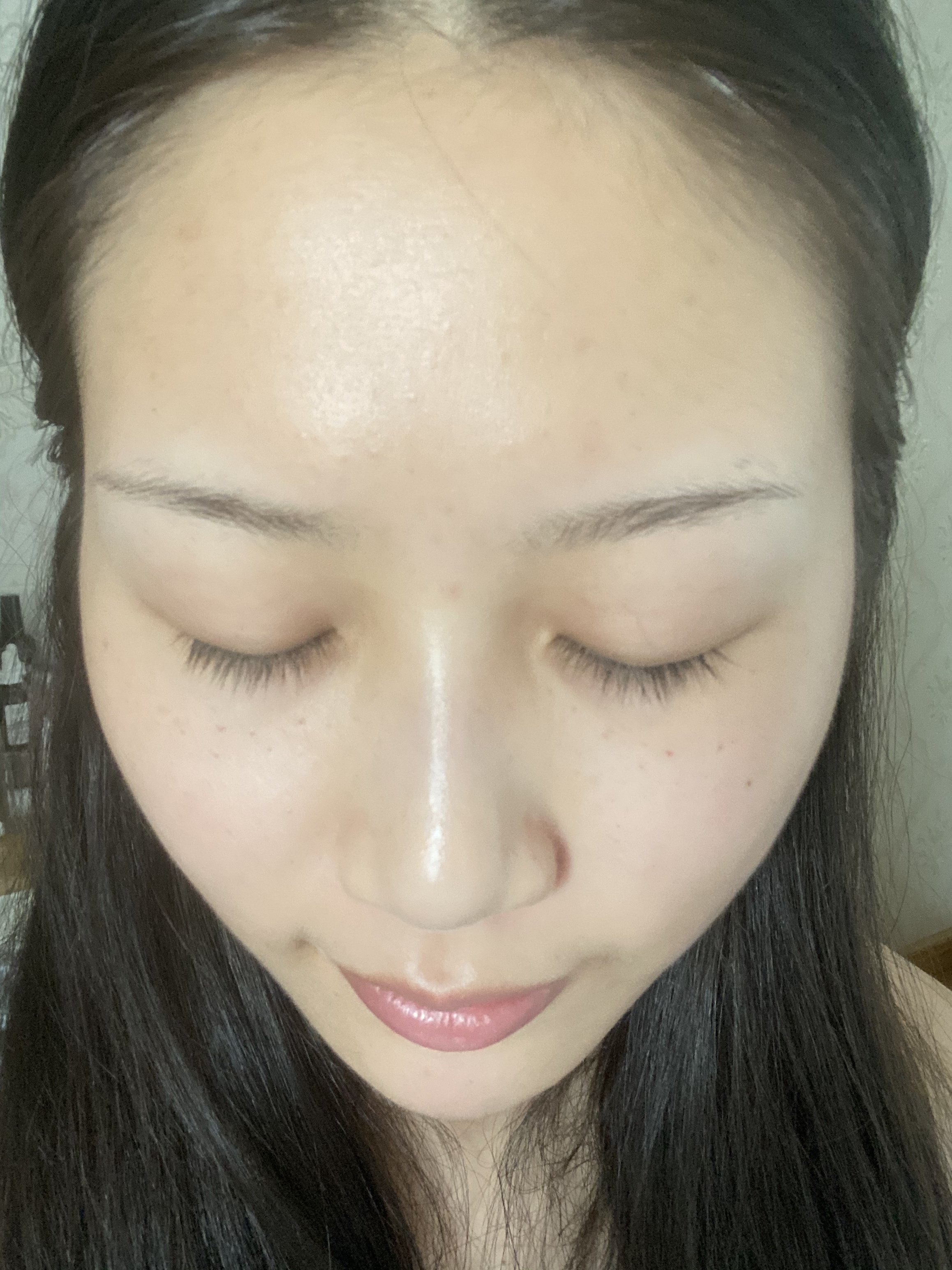 今天做完微针第二天已经褪红结痂啦,我恢复的很快,期待后面的变化