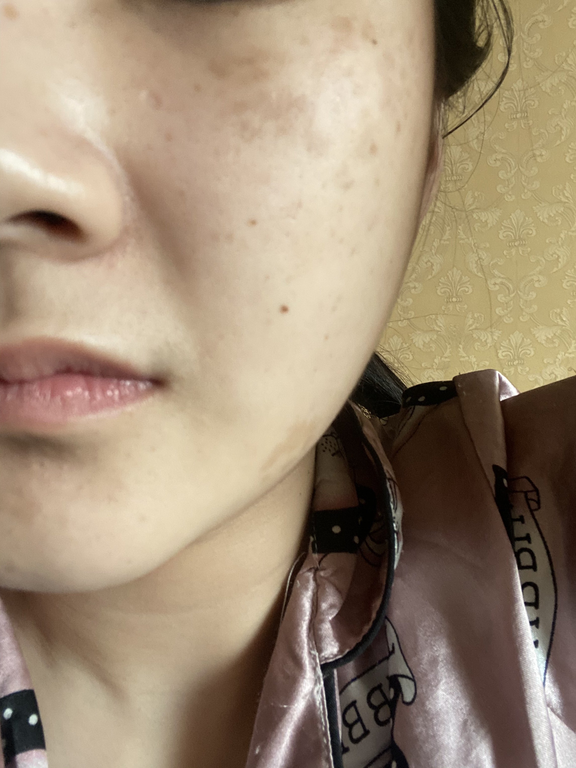 皮秒激光要打几次才能把褐青色痣消掉