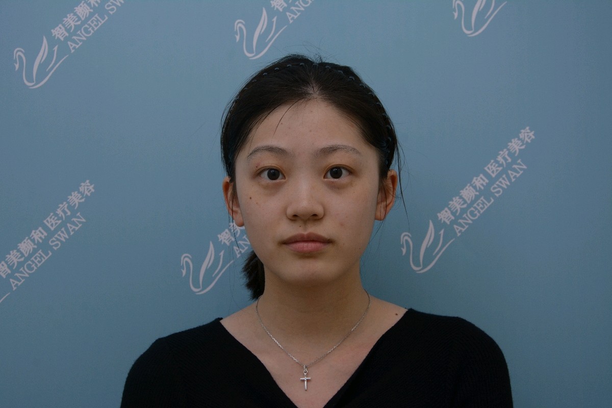 光子嫩肤是能量越大效果越好吗 新氧美容整形