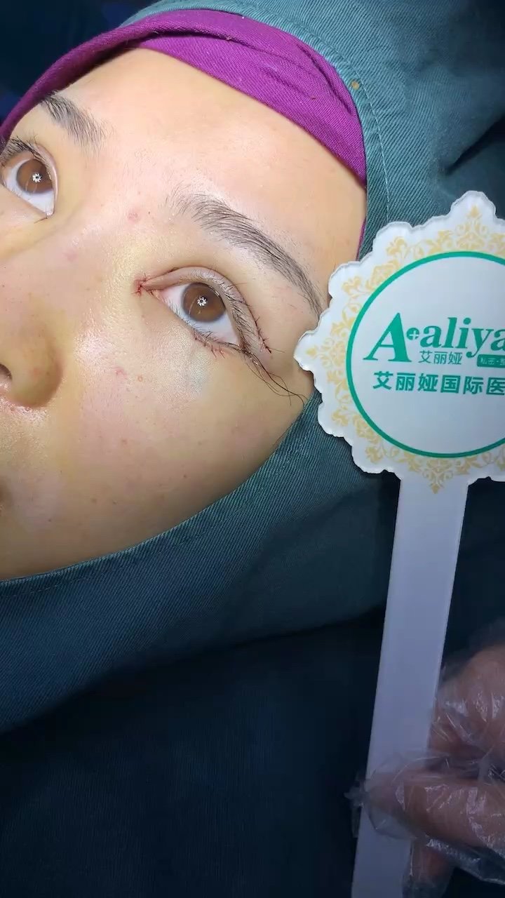 全切双眼皮开眼角眼睑下至3项术后即刻效果