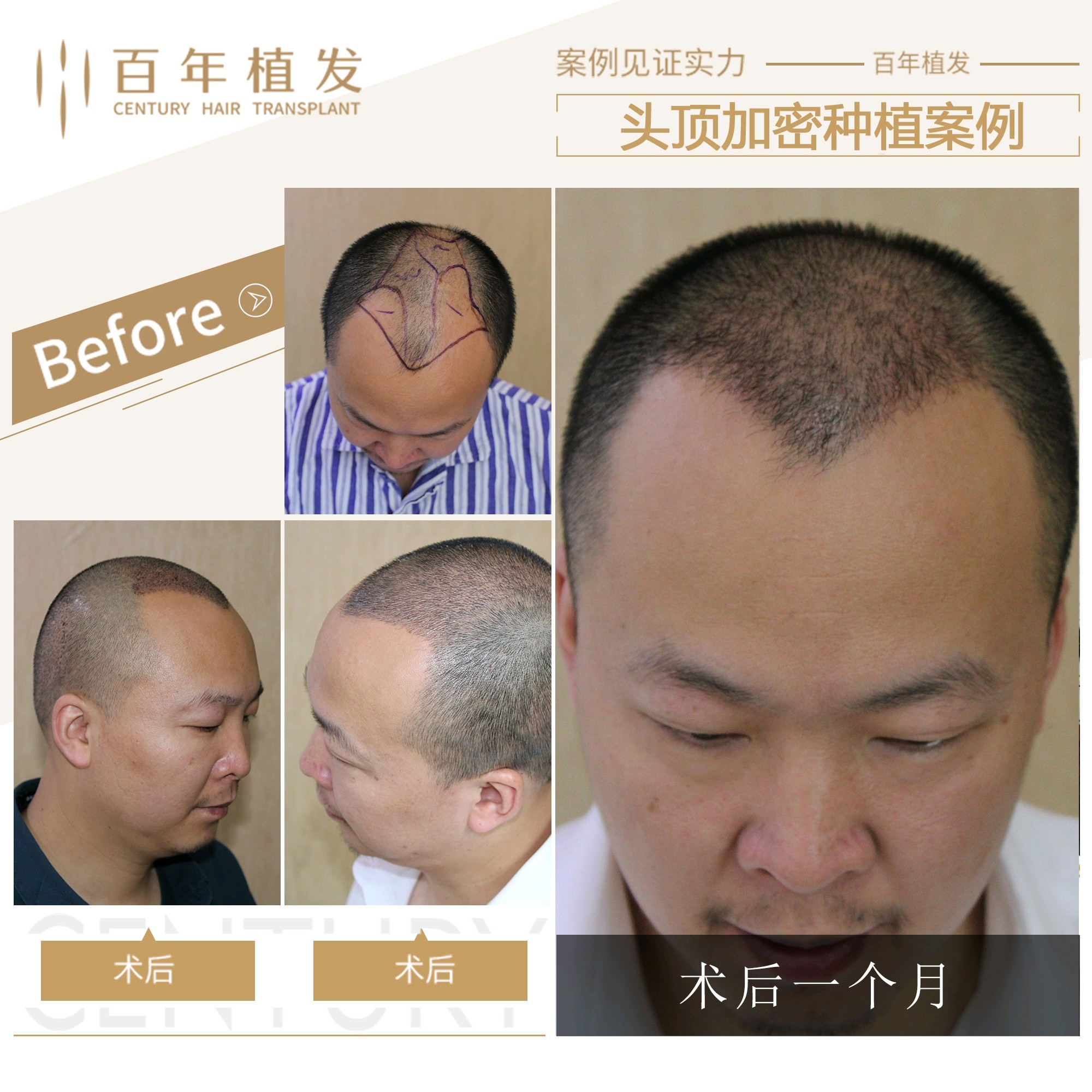 植发的原理是什么 新氧美容整形