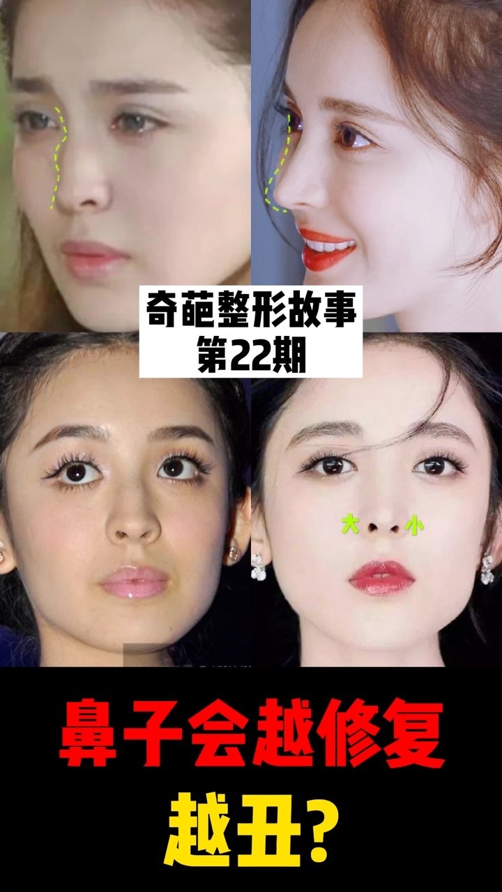 鼻子会越修复越修复丑么娜扎的鼻子出错在哪里