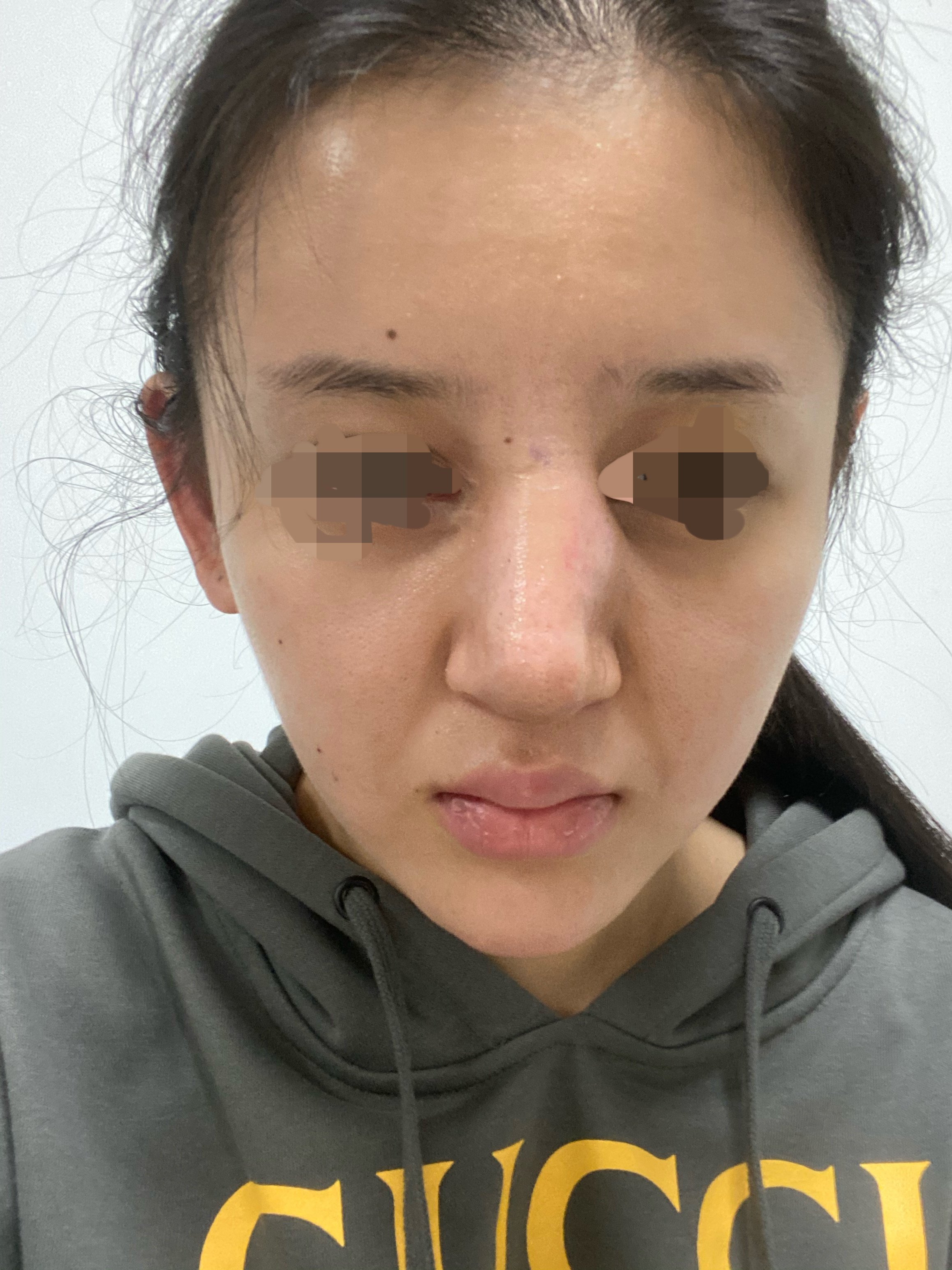 隆鼻拆线后拆线当天肿了说是有渗血还在消肿期这才第七天求有经验的