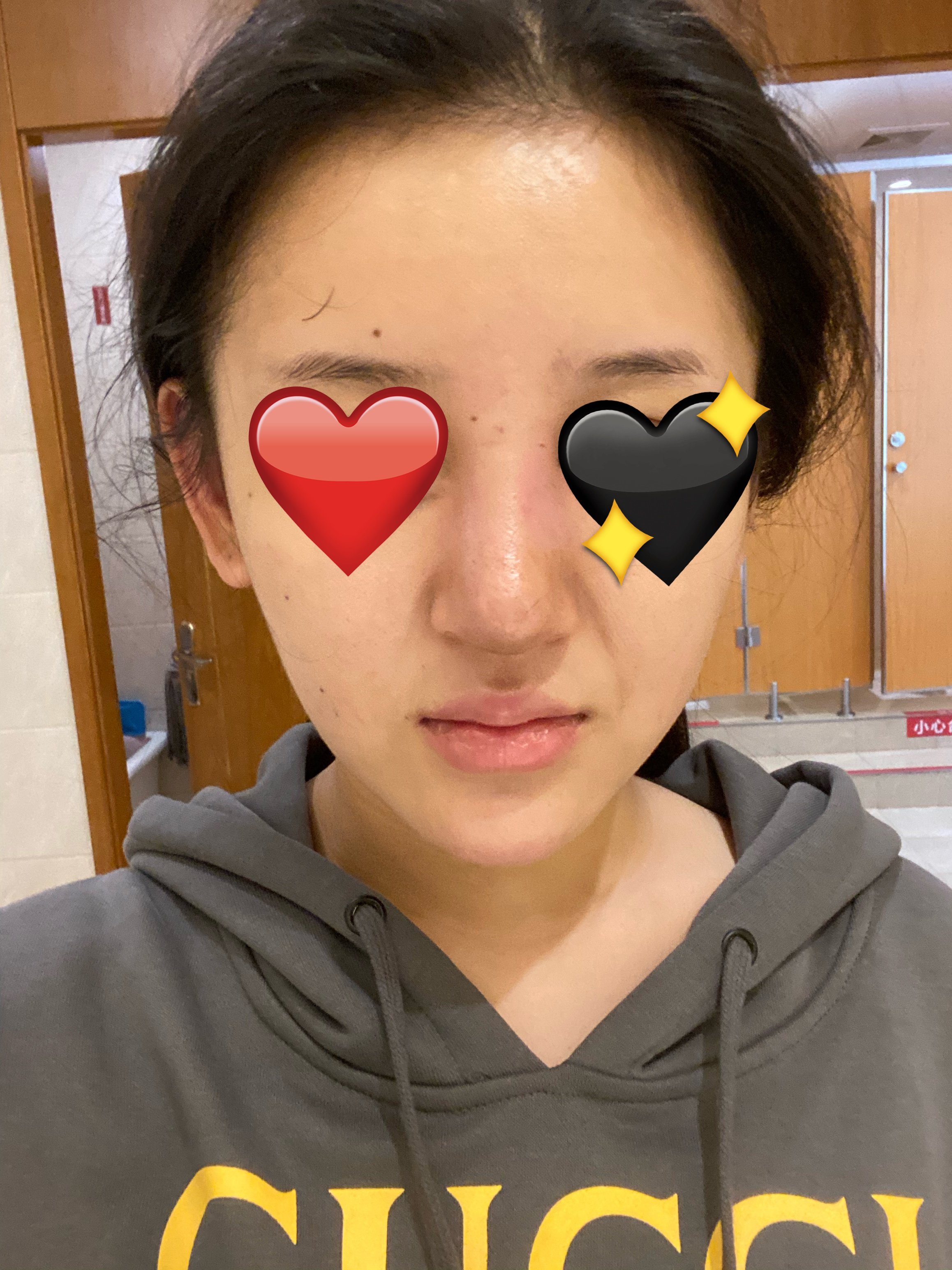 隆鼻拆线后拆线当天肿了说是有渗血还在消肿期这才第七天求有经验的