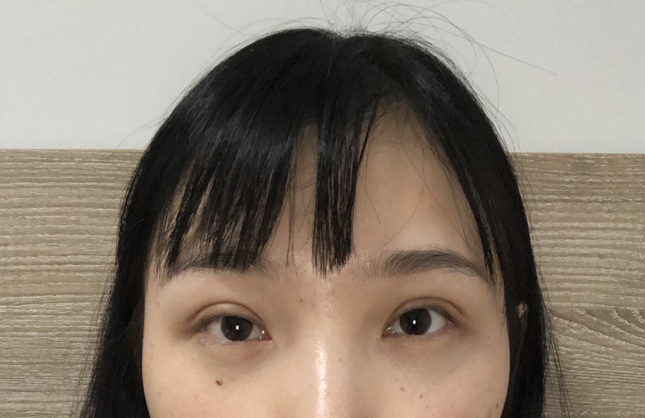 双眼皮术后天大小眼明显是失败了吗