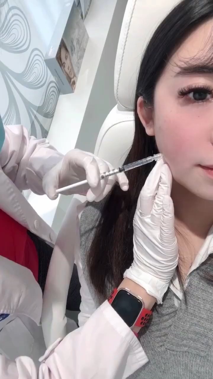 咬肌注射瘦脸针紧致轮廓面部提升玻尿酸填充下巴