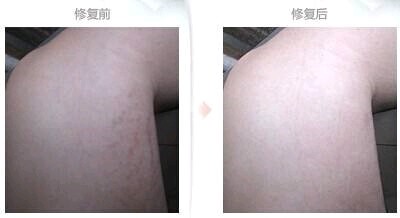 膨胀纹:又叫萎缩纹,生长纹或妊娠纹