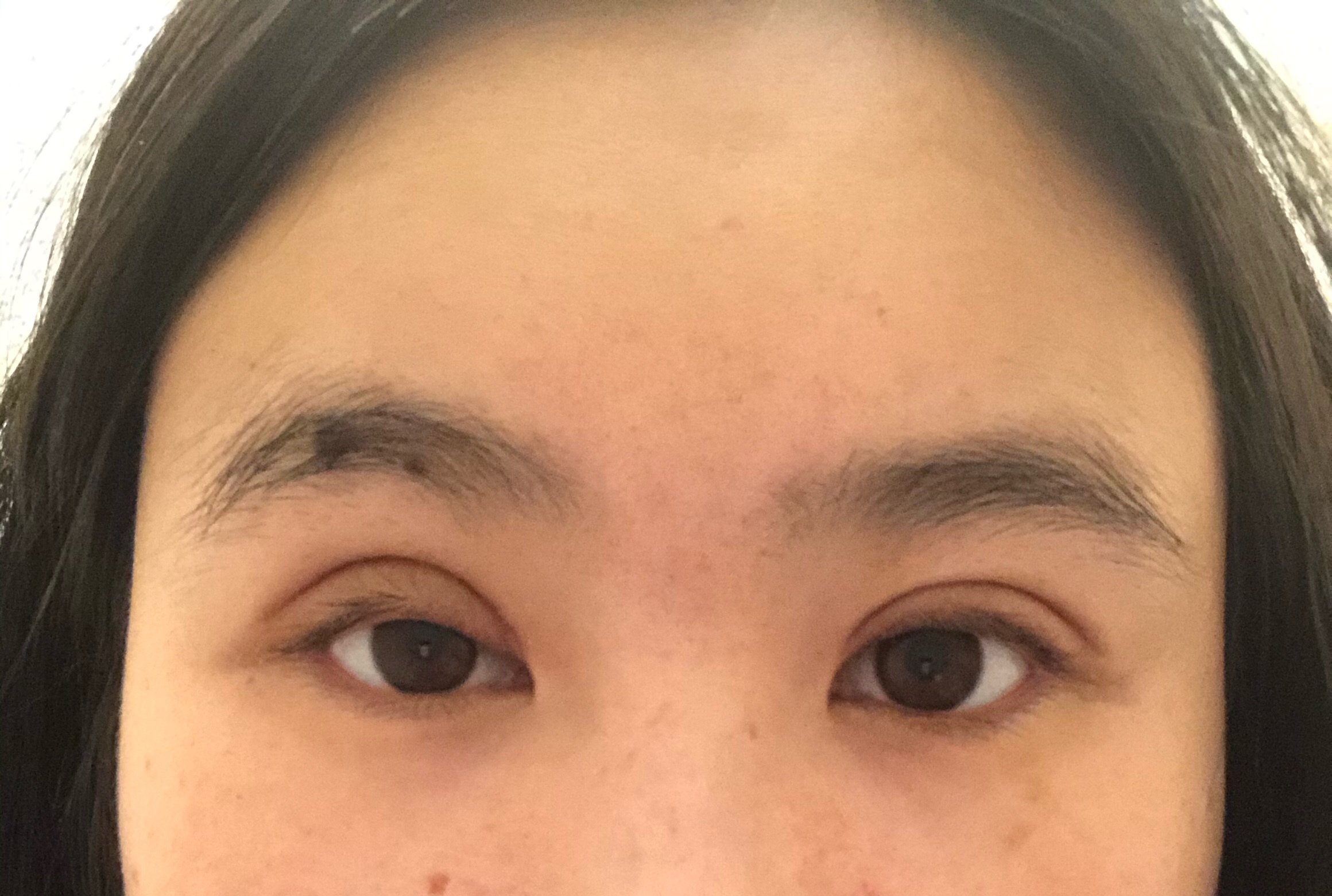 眼皮右眼做了上眼提肌现在天了两只眼睛和双眼皮都不一样大是失败了么