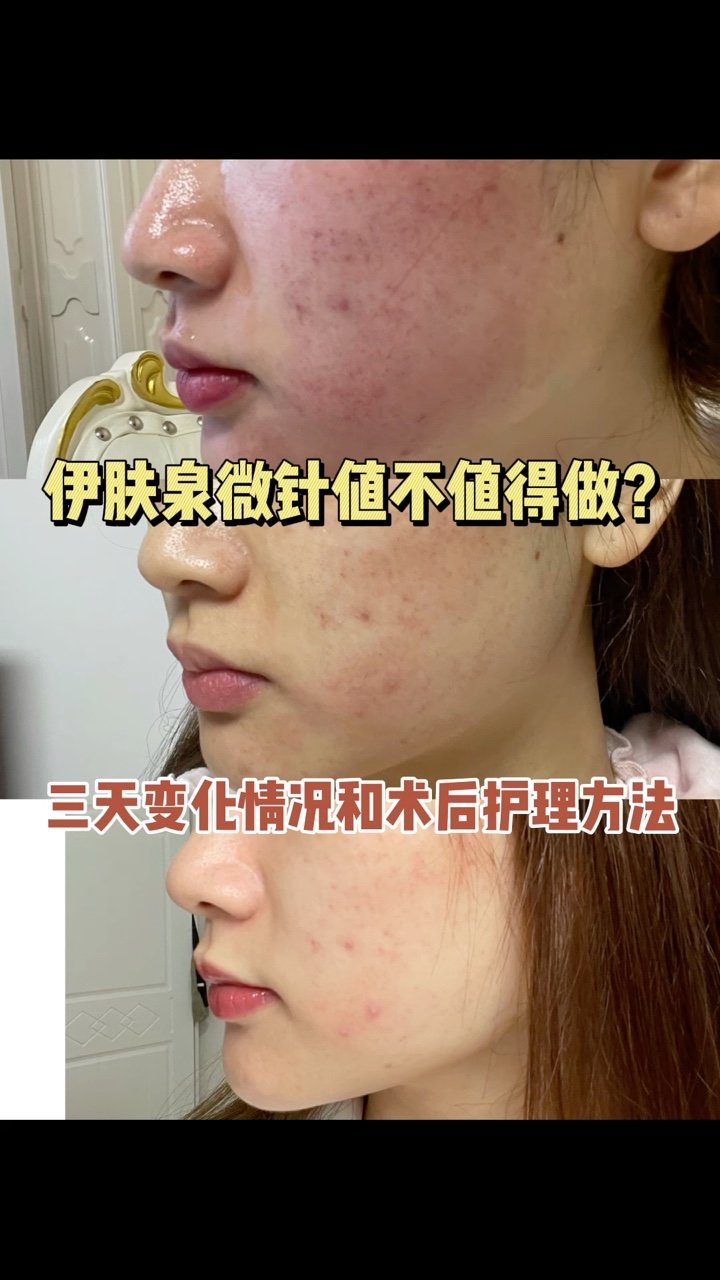伊肤泉微针第三天,开始爆痘了,但是红消下去了很多,_圈子-新氧美容