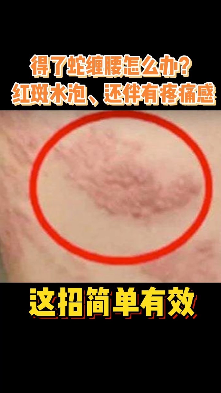 得了蛇缠腰该怎么办